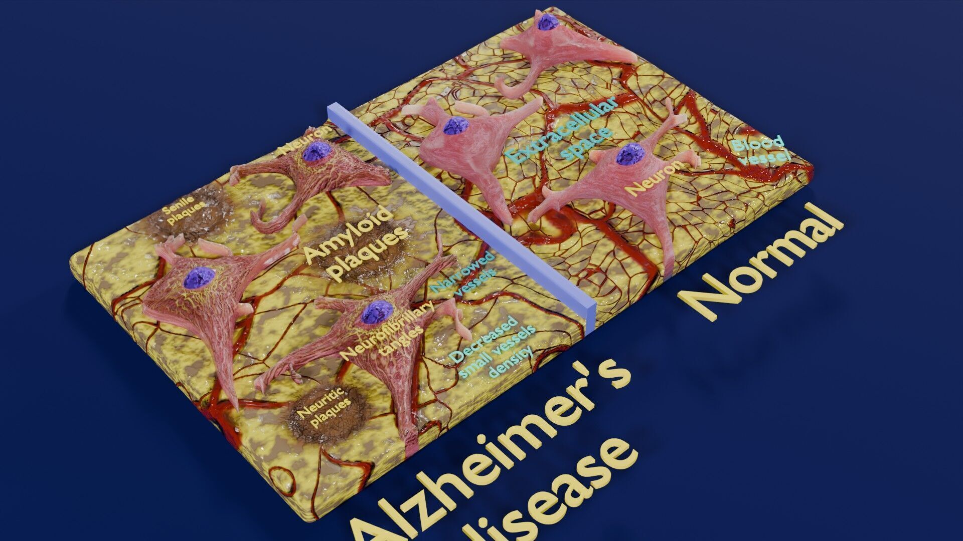 Alzheimer disease microscopy changes brain Low-poly 3D model_25