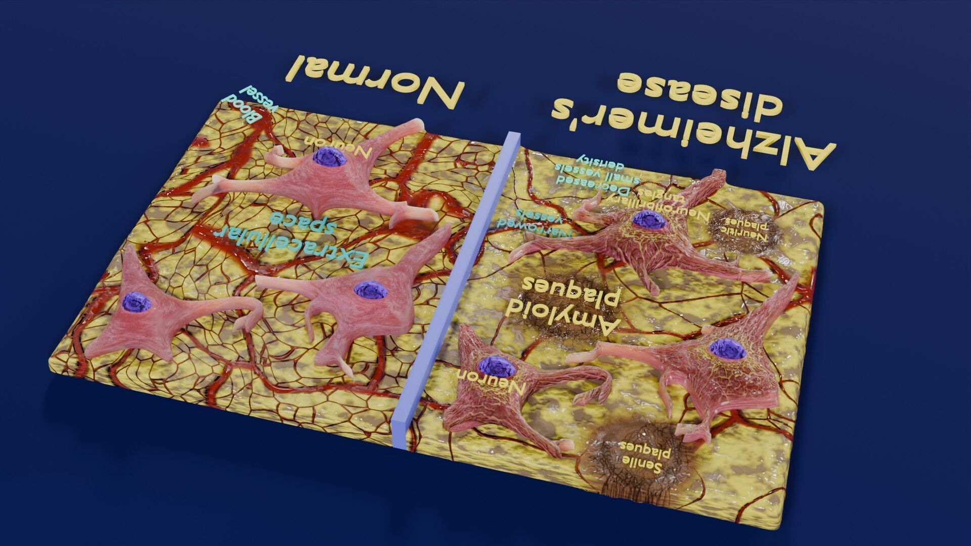 Alzheimer disease microscopy changes brain Low-poly 3D model_37