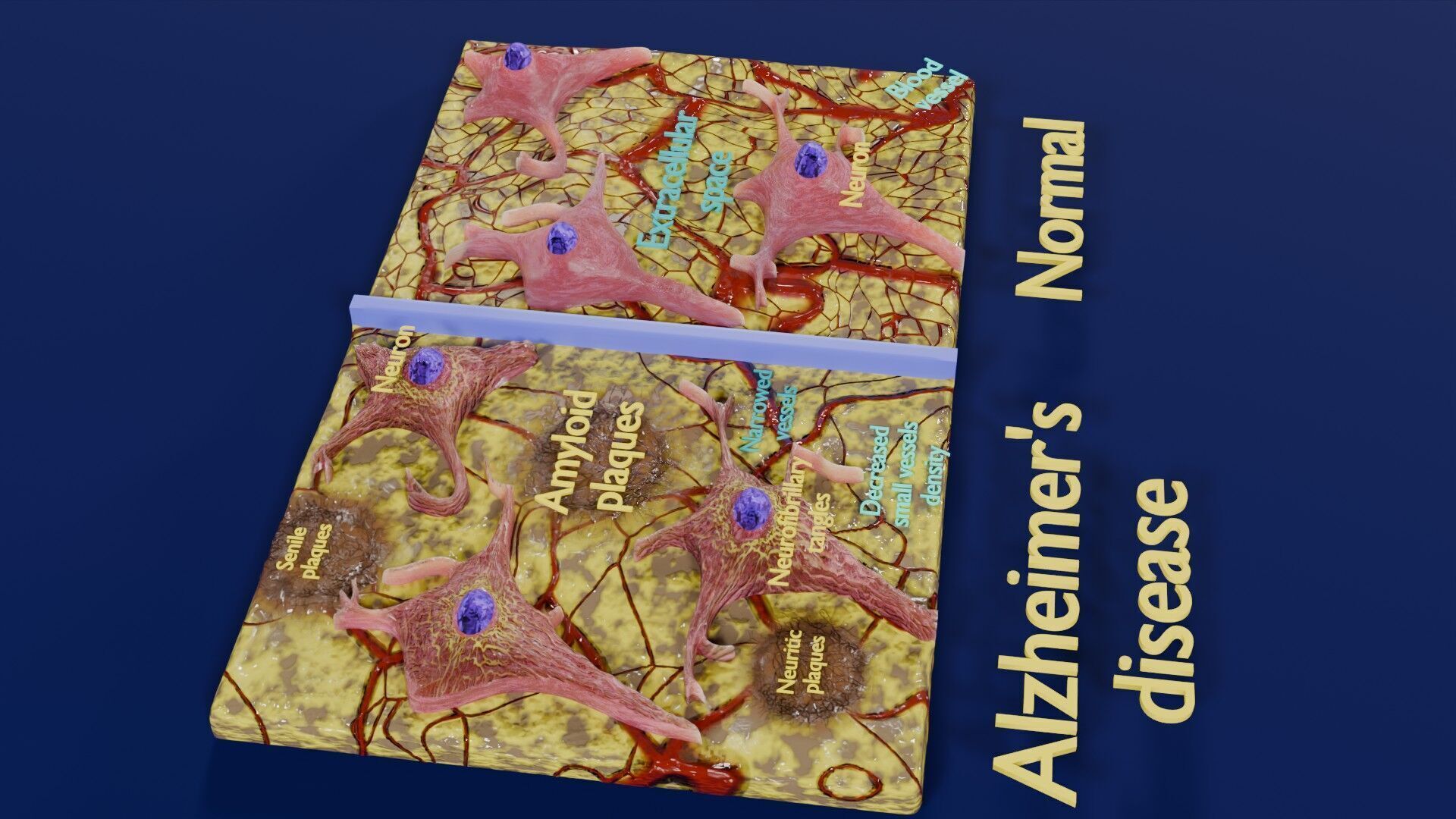Alzheimer disease microscopy changes brain Low-poly 3D model_29