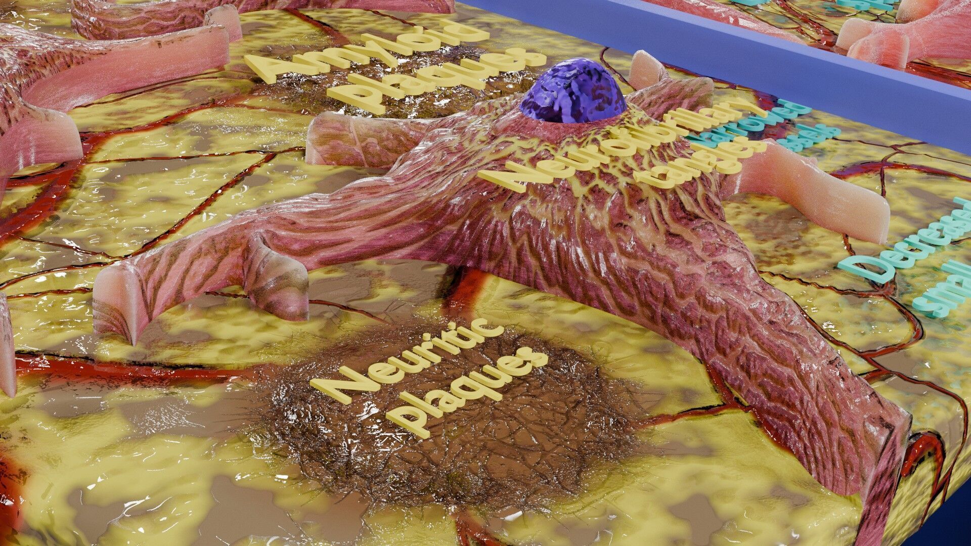 Alzheimer disease microscopy changes brain Low-poly 3D model_19