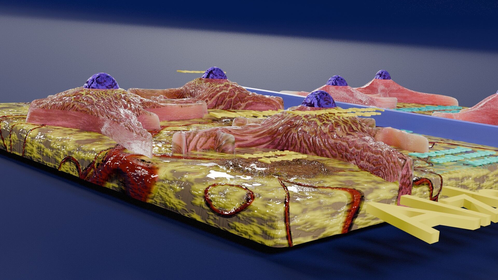 Alzheimer disease microscopy changes brain Low-poly 3D model_16