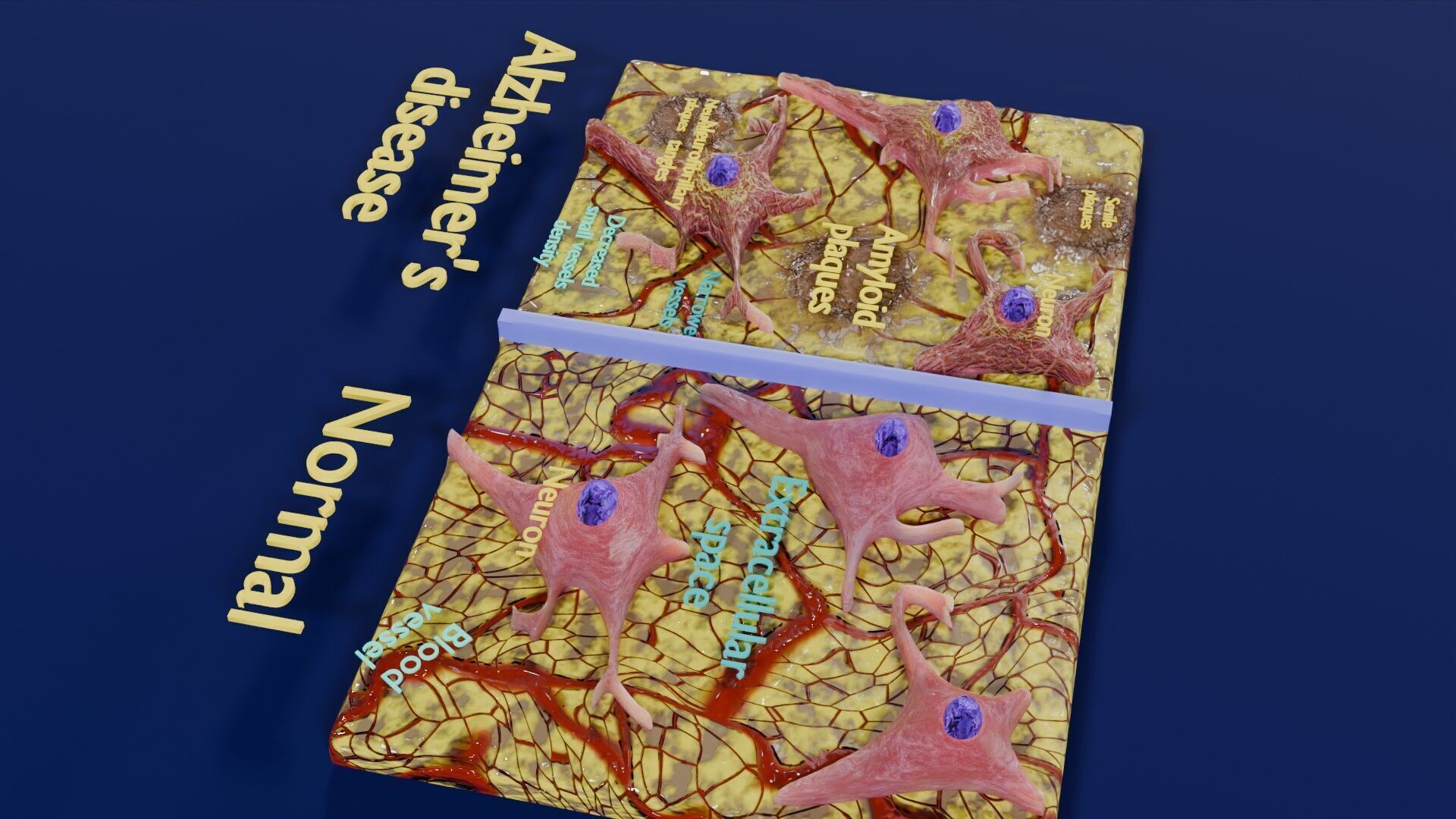 Alzheimer disease microscopy changes brain Low-poly 3D model_46