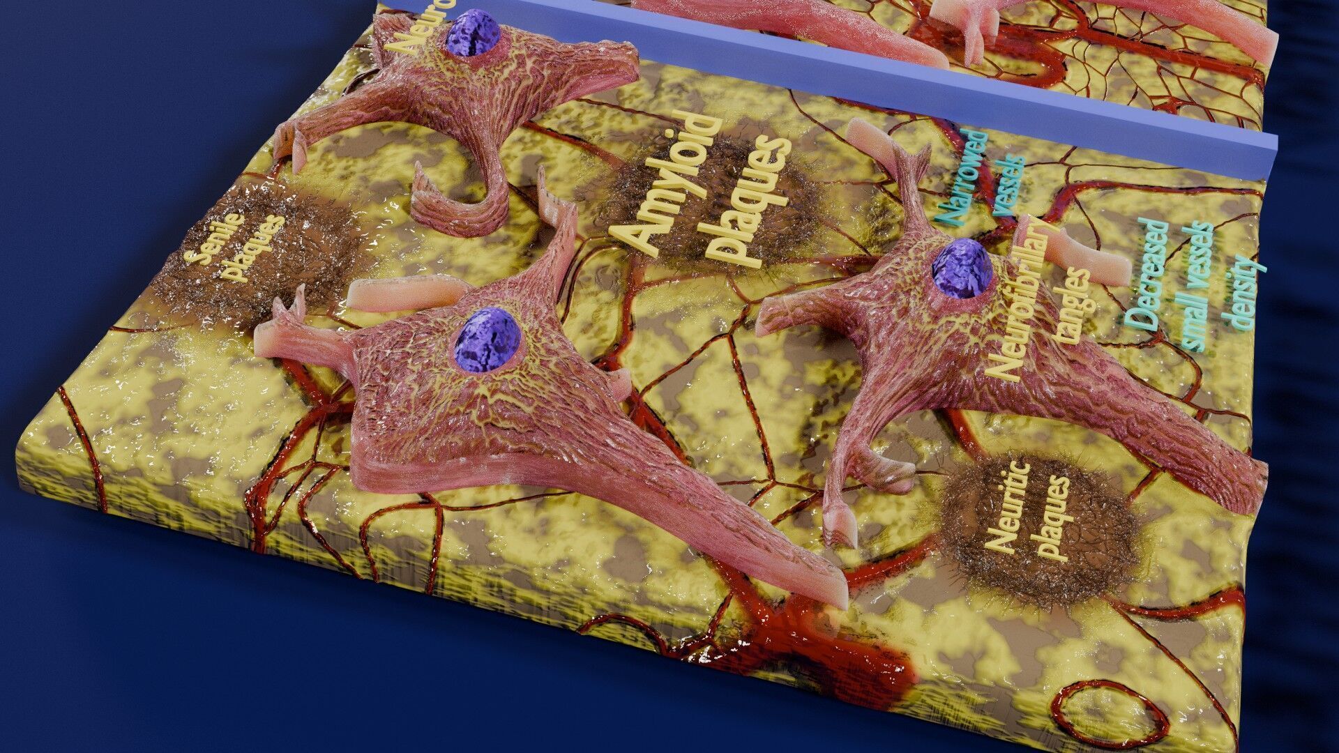 Alzheimer disease microscopy changes brain Low-poly 3D model_13