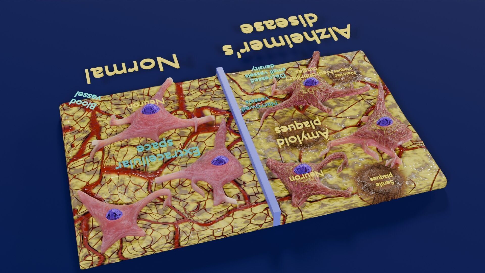 Alzheimer disease microscopy changes brain Low-poly 3D model_40