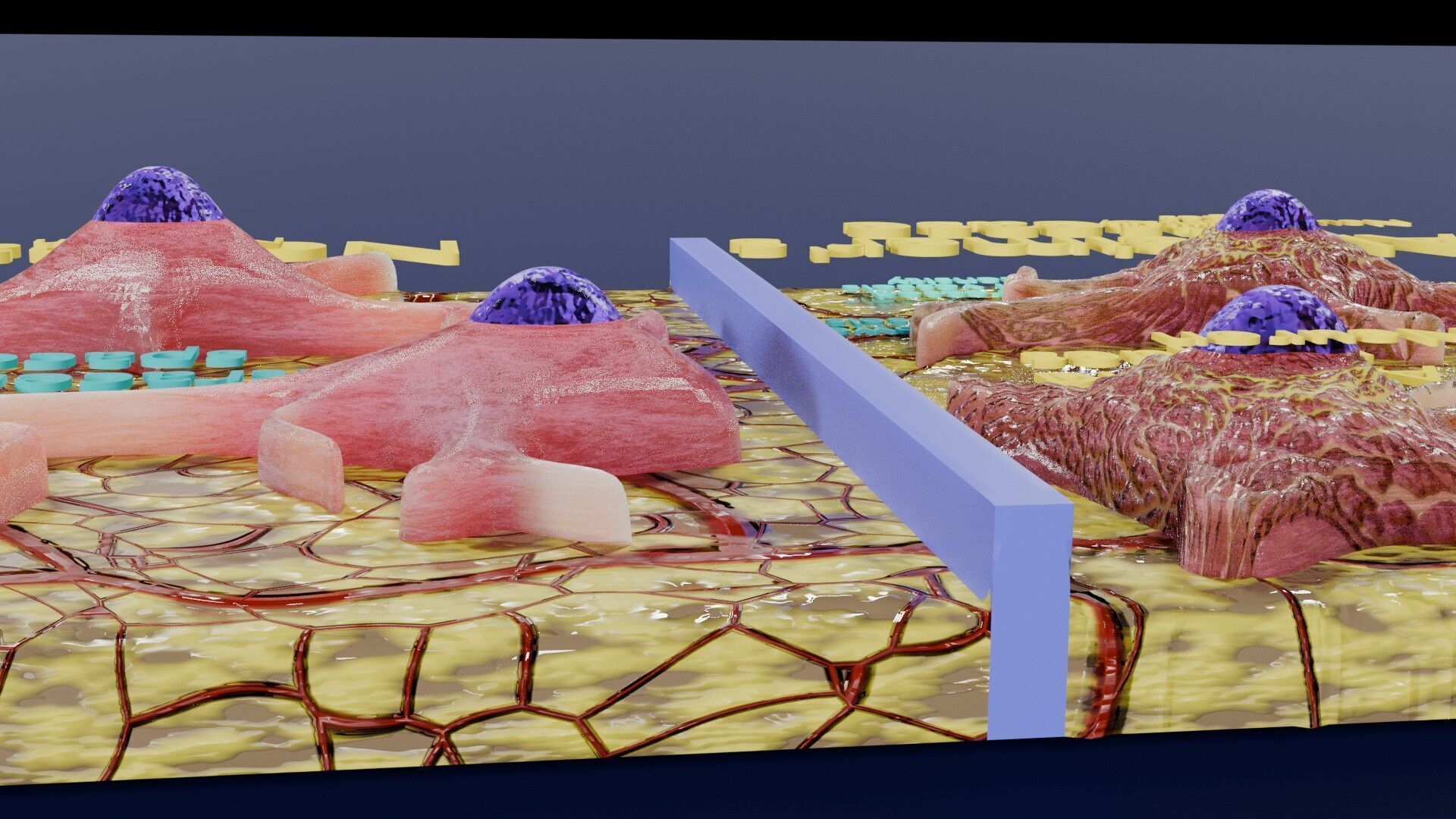 Alzheimer disease microscopy changes brain Low-poly 3D model_9