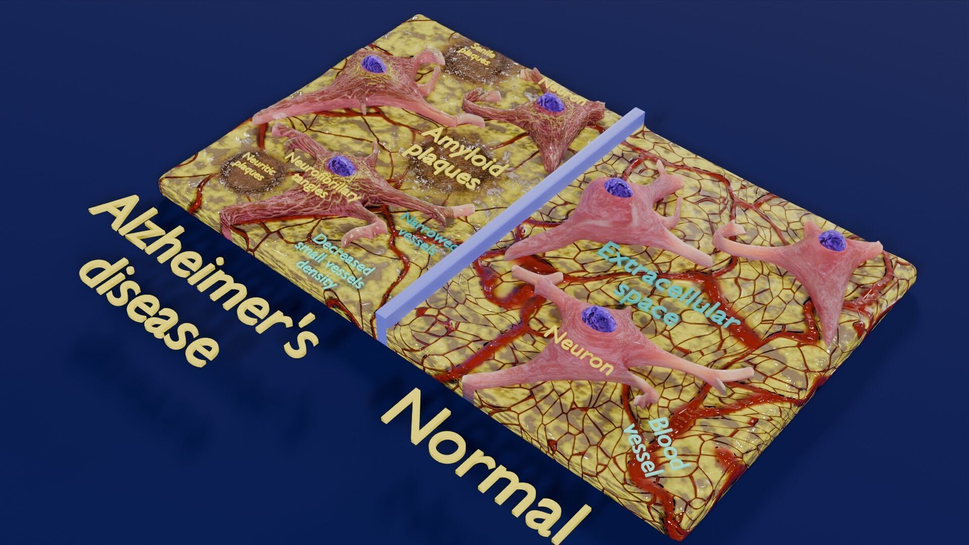 Alzheimer disease microscopy changes brain Low-poly 3D model_52