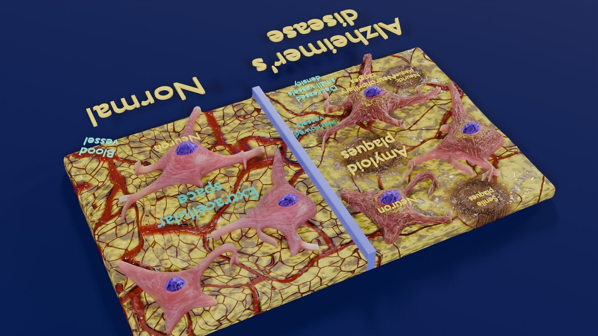 Alzheimer disease microscopy changes brain Low-poly 3D model_41