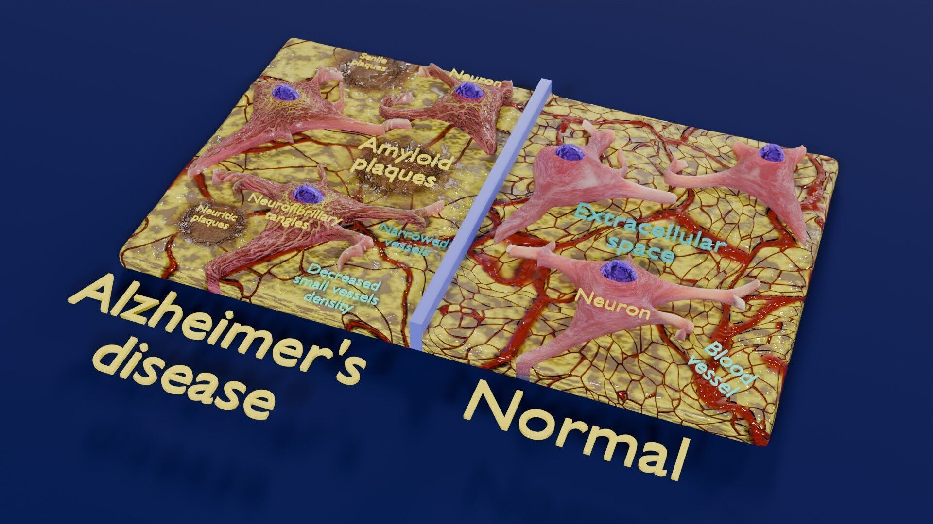 Alzheimer disease microscopy changes brain Low-poly 3D model_54
