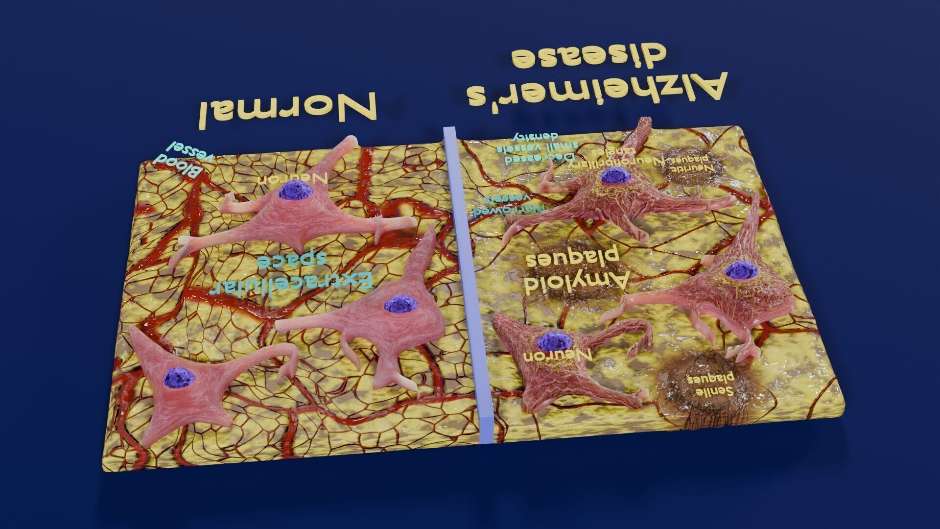 Alzheimer disease microscopy changes brain Low-poly 3D model_39
