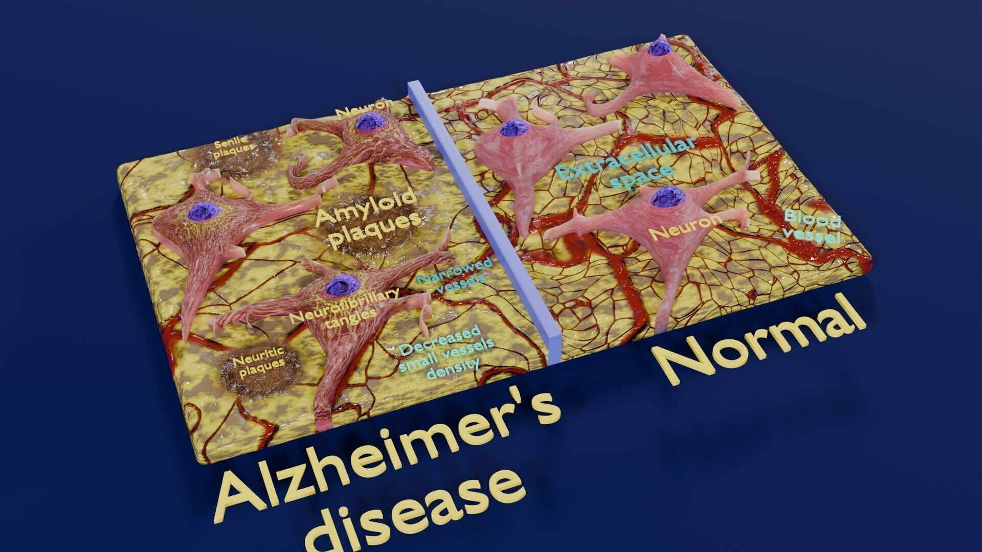 Alzheimer disease microscopy changes brain Low-poly 3D model_23