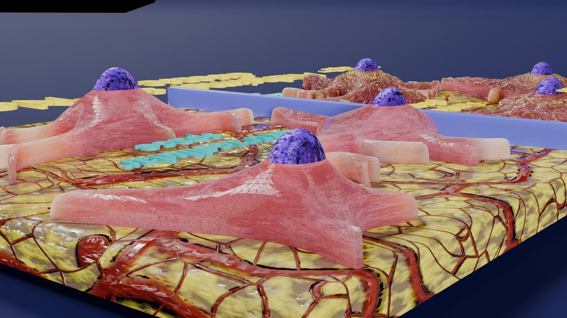Alzheimer disease microscopy changes brain Low-poly 3D model_8