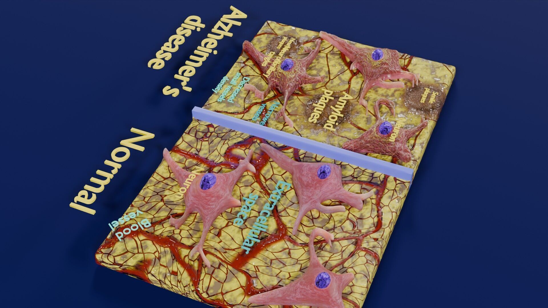 Alzheimer disease microscopy changes brain Low-poly 3D model_45