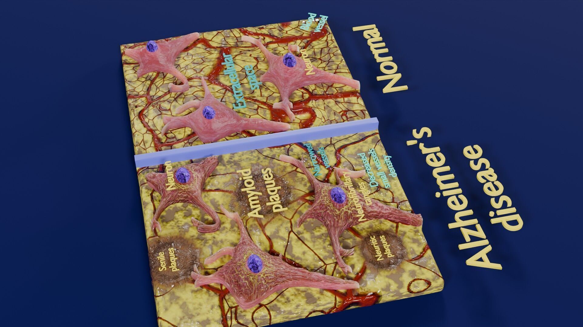 Alzheimer disease microscopy changes brain Low-poly 3D model_31