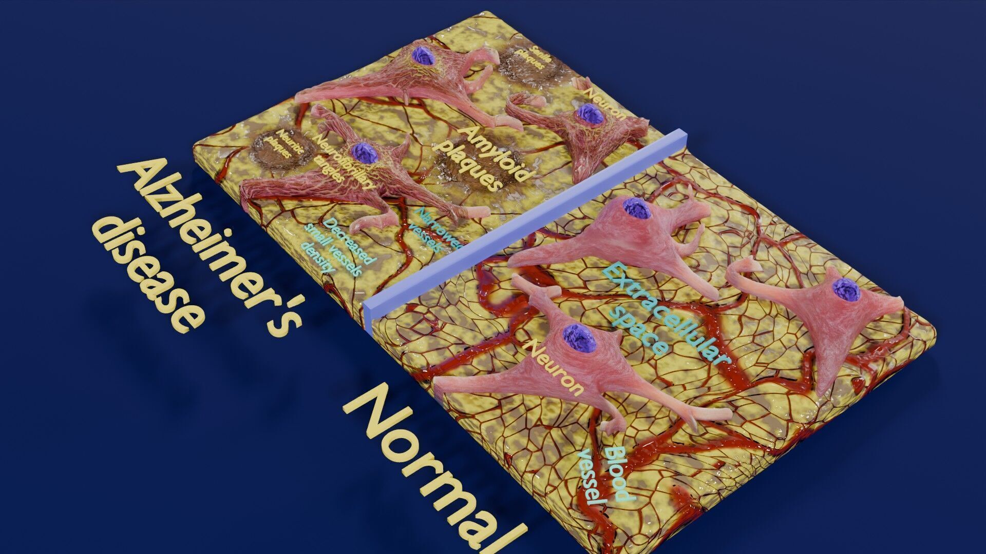 Alzheimer disease microscopy changes brain Low-poly 3D model_51
