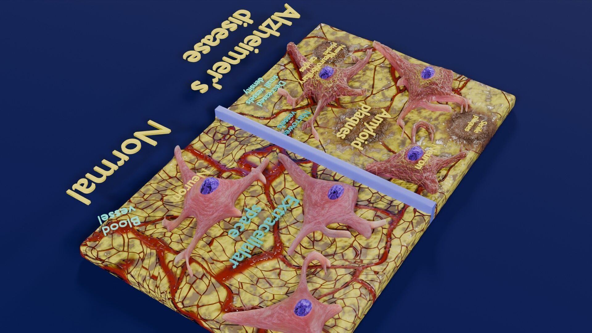 Alzheimer disease microscopy changes brain Low-poly 3D model_44