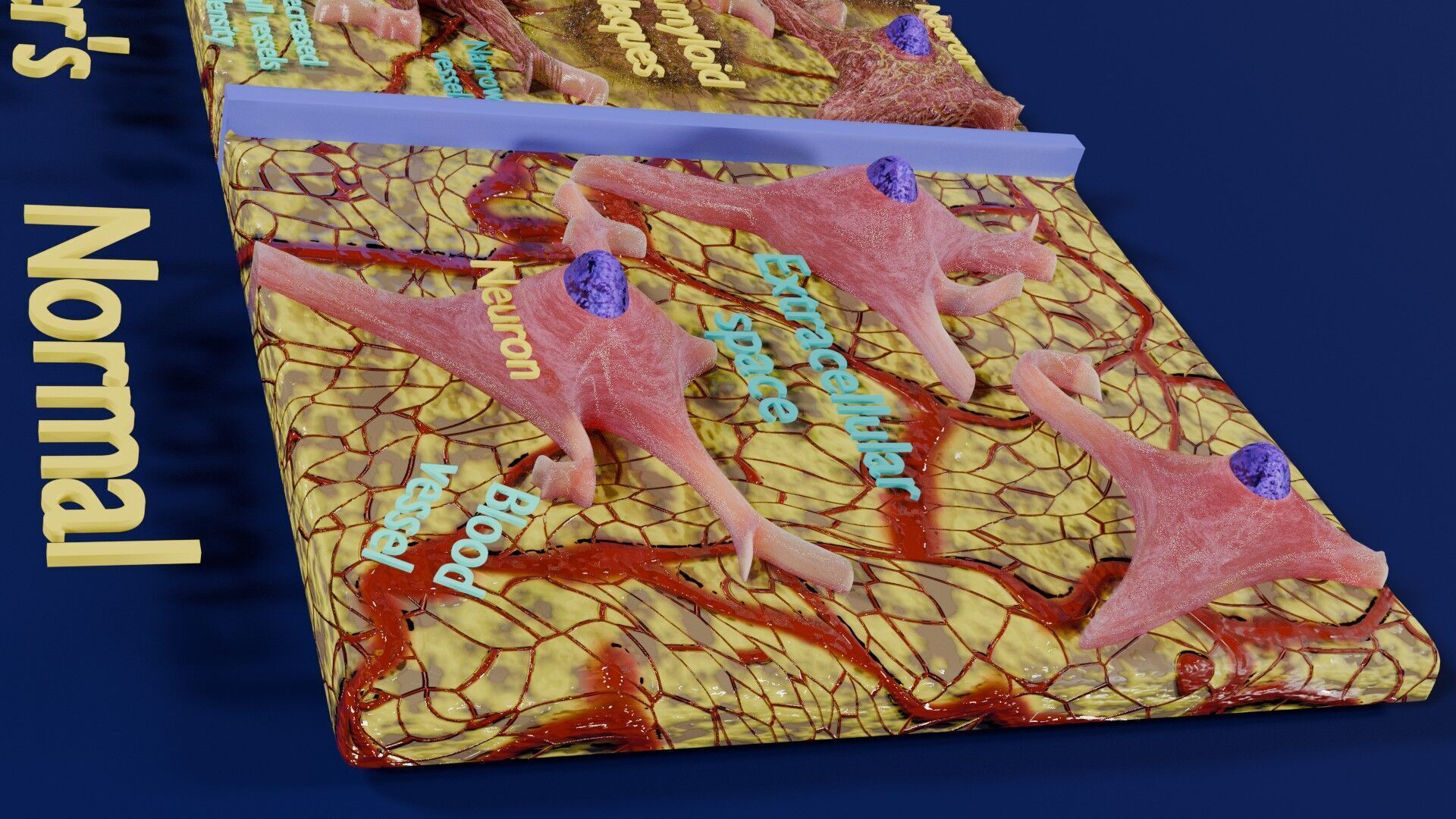 Alzheimer disease microscopy changes brain Low-poly 3D model_5