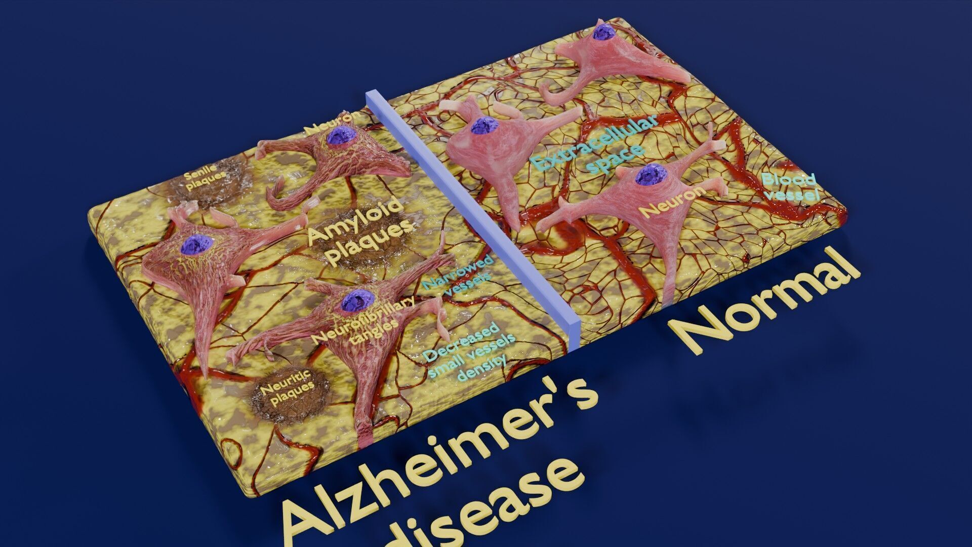 Alzheimer disease microscopy changes brain Low-poly 3D model_24