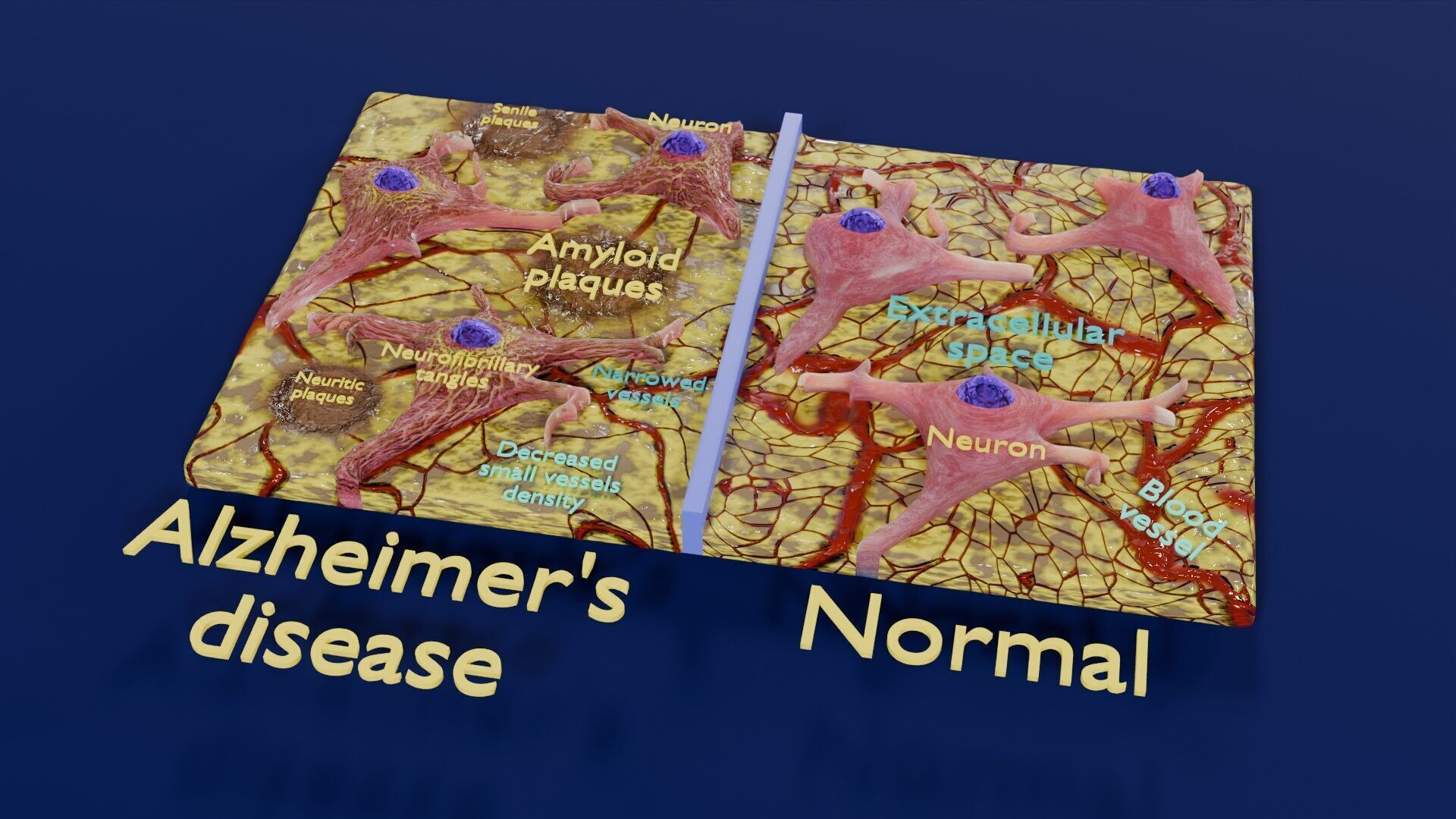 Alzheimer disease microscopy changes brain Low-poly 3D model_55