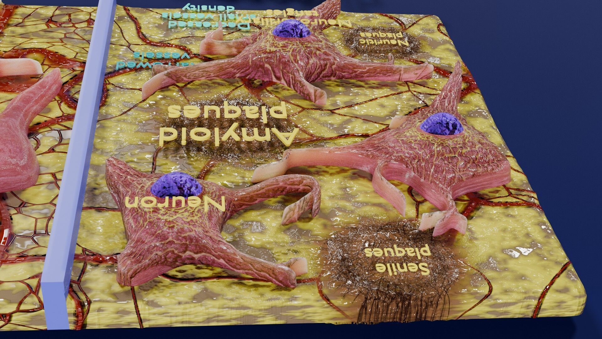 Alzheimer disease microscopy changes brain Low-poly 3D model_11