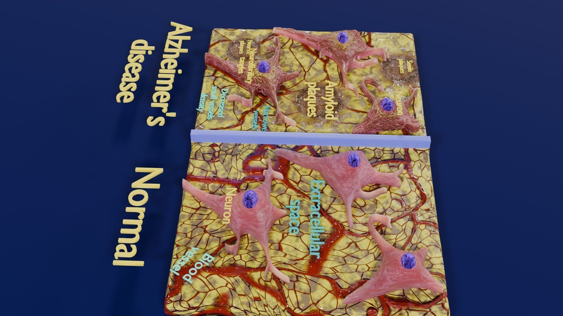 Alzheimer disease microscopy changes brain Low-poly 3D model_47