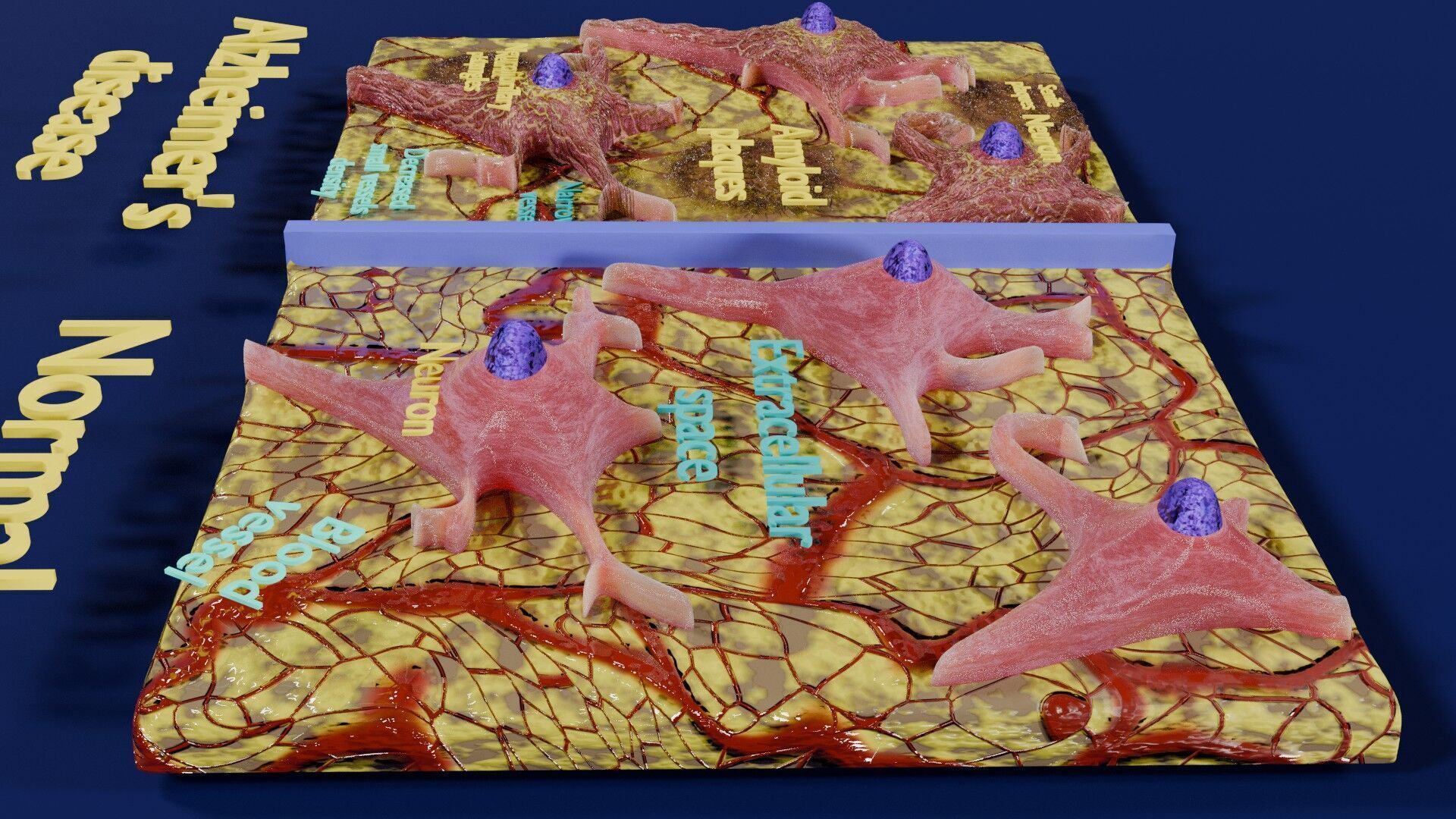 Alzheimer disease microscopy changes brain Low-poly 3D model_6
