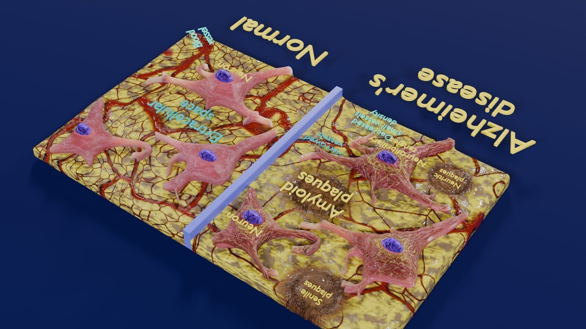 Alzheimer disease microscopy changes brain Low-poly 3D model_35