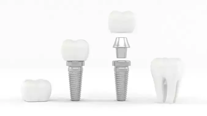 Tooth Implants 3D model