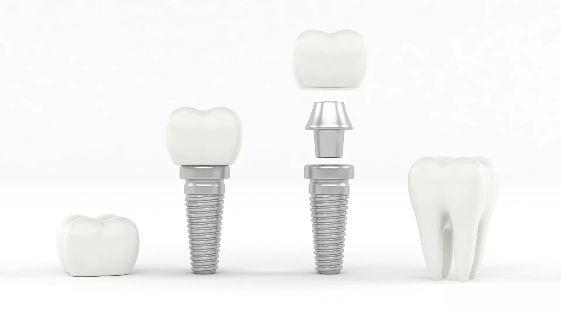 Tooth Implants 3D model