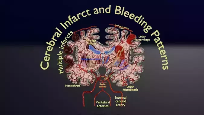 Stroke brain infarct hemorrhage types Low-poly 3D model