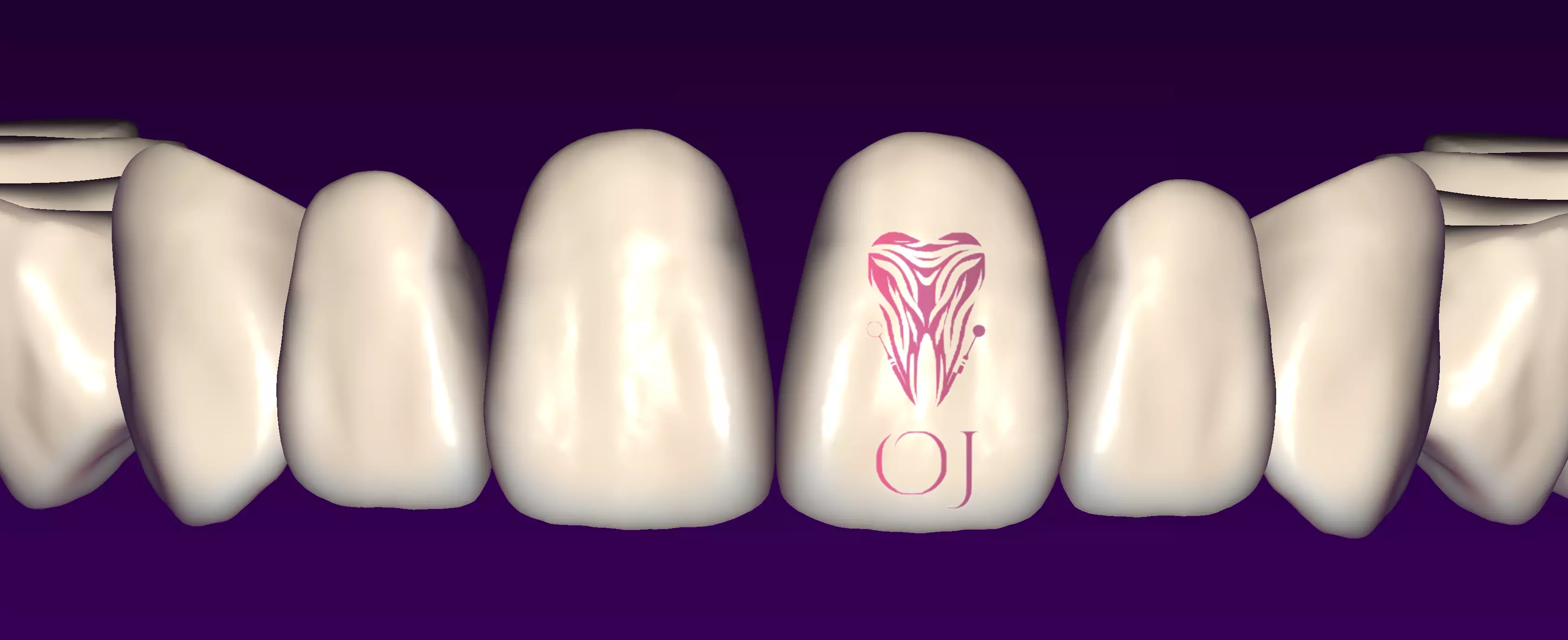 OJ RICK Exocad library 3D print model