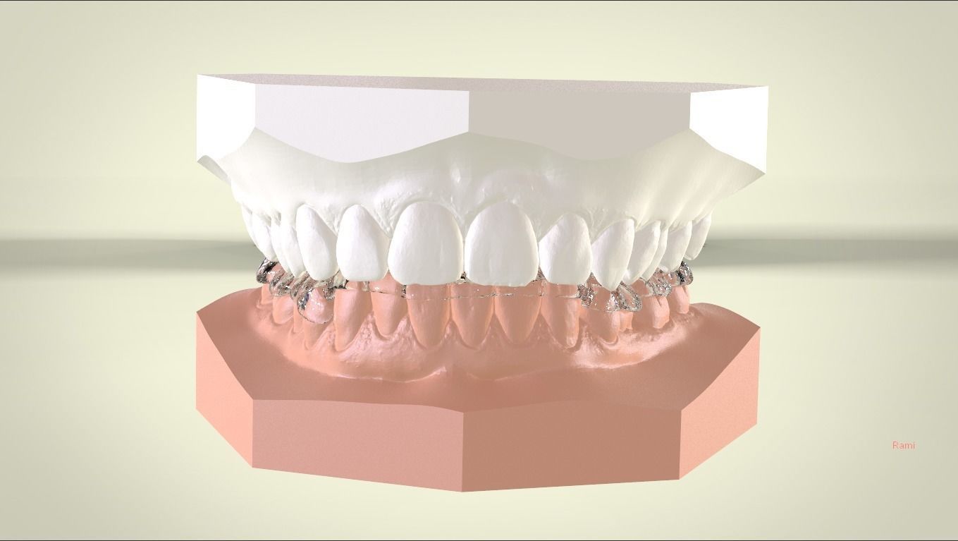 Digital Tanner Ortho Repositioning Splint 3D print model