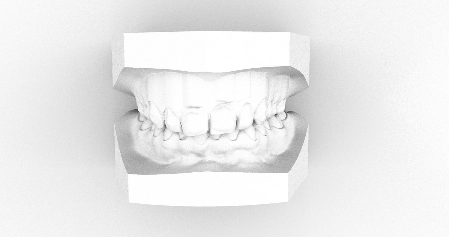 Digital Dental Bleaching Tray 3D print model_2