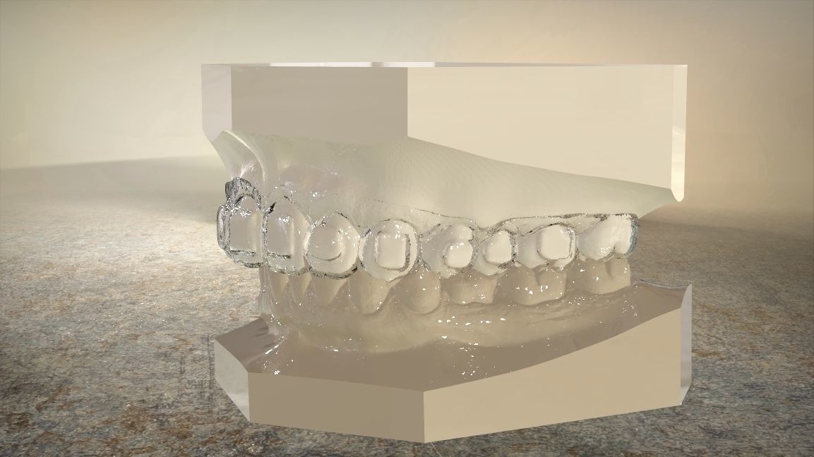 Digital Dental Bleaching Tray 3D print model_5