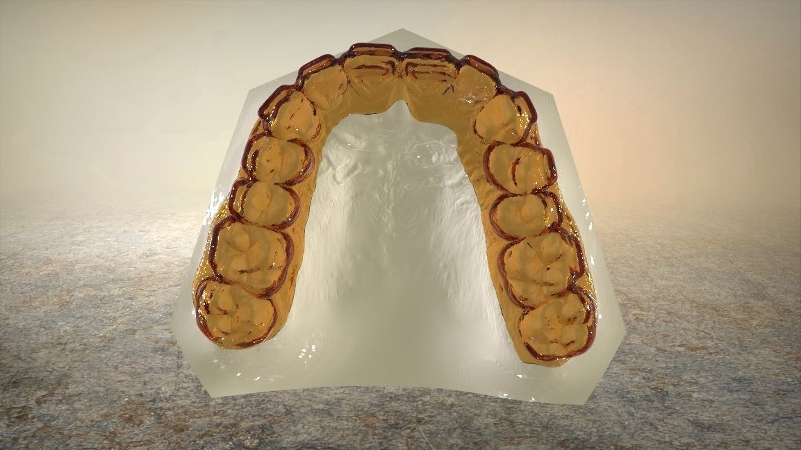 Digital Dental Bleaching Tray 3D print model_8