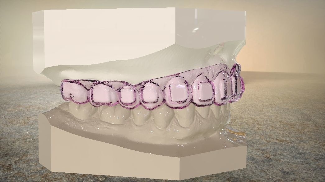 Digital Dental Bleaching Tray 3D print model_6