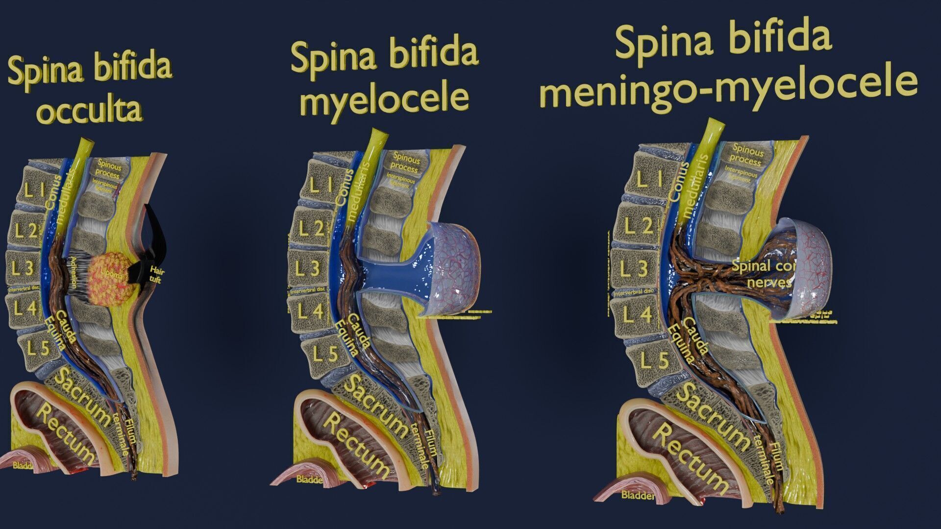 Spina bifida Neural Tube Defect Low-poly 3D model_10