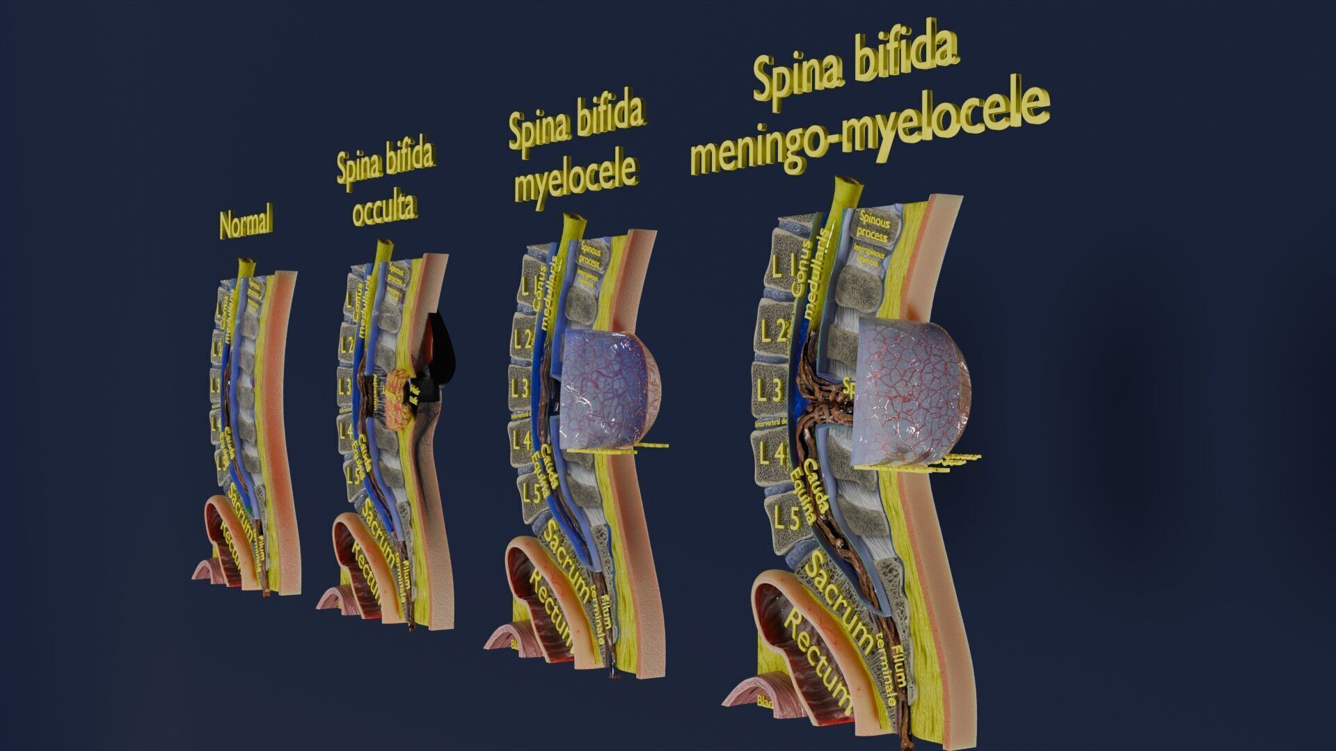 Spina bifida Neural Tube Defect Low-poly 3D model_2