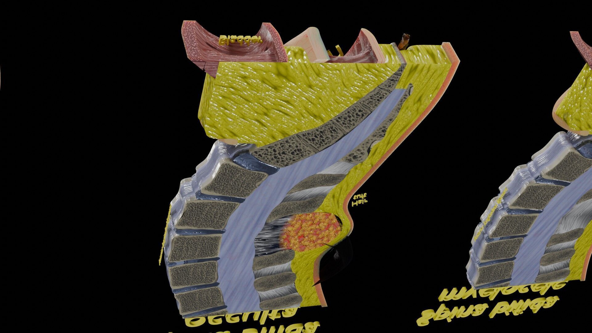 Spina bifida Neural Tube Defect Low-poly 3D model_58