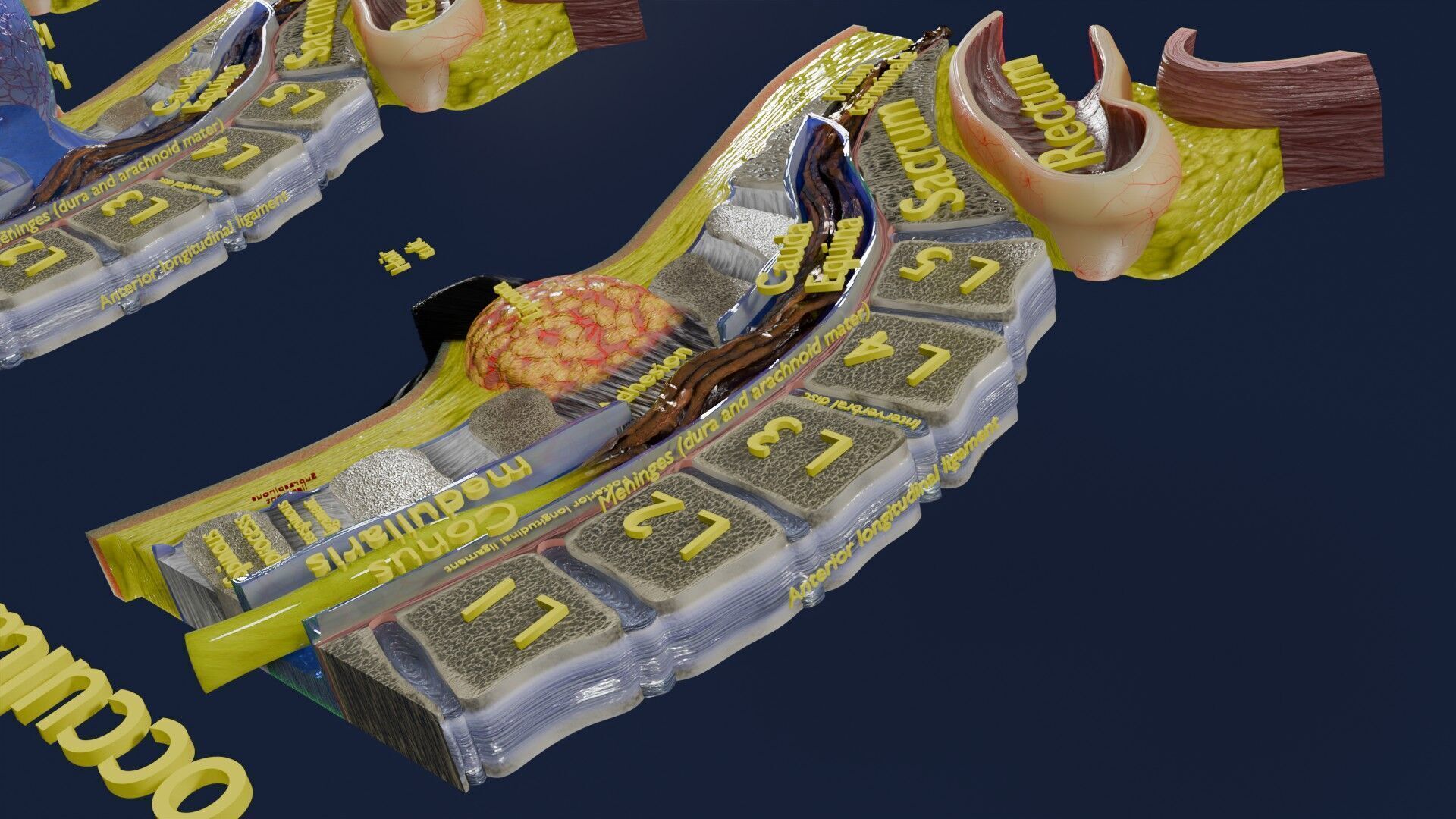 Spina bifida Neural Tube Defect Low-poly 3D model_23