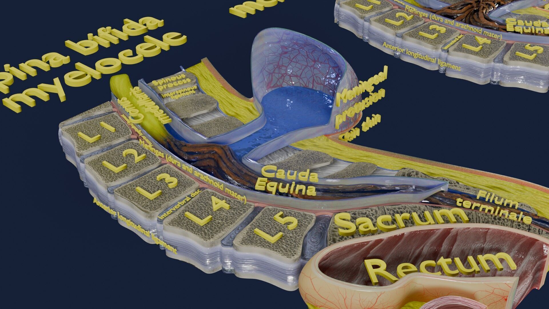 Spina bifida Neural Tube Defect Low-poly 3D model_36