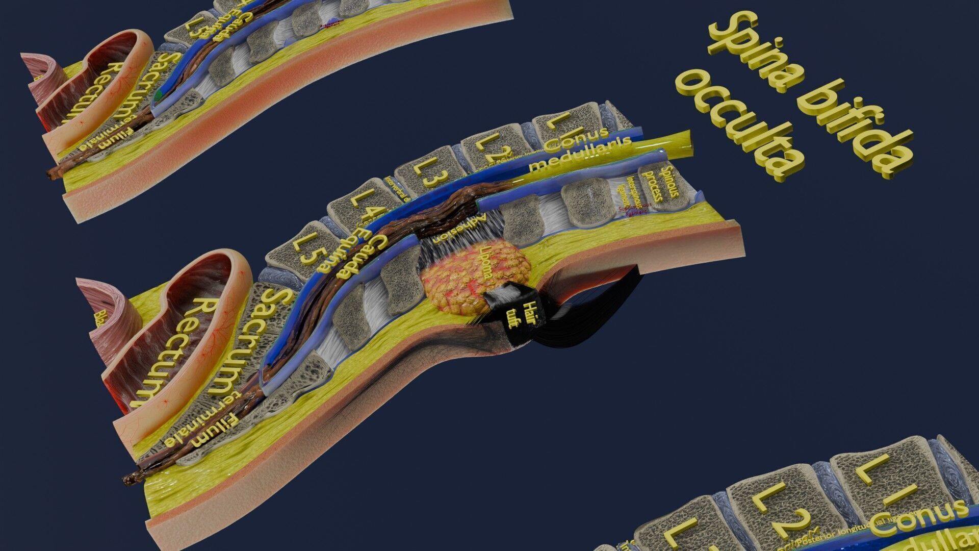 Spina bifida Neural Tube Defect Low-poly 3D model_32
