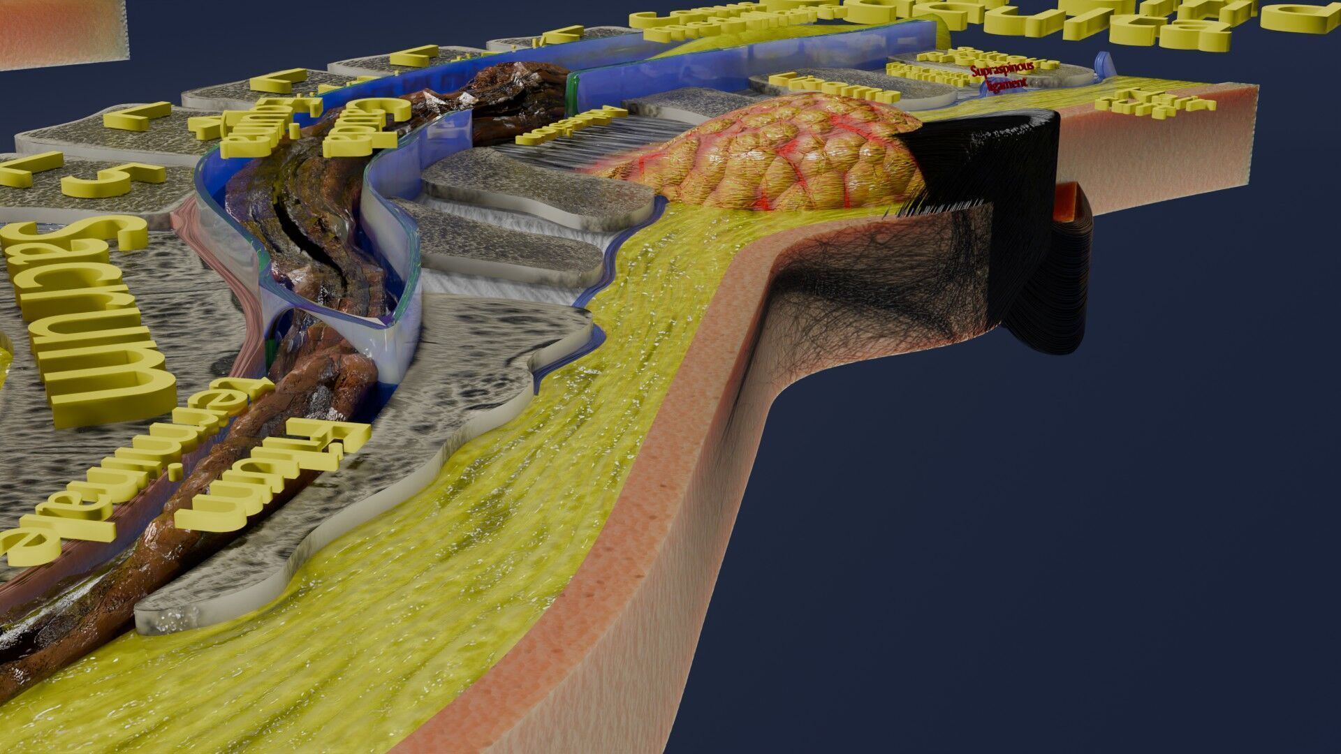 Spina bifida Neural Tube Defect Low-poly 3D model_54