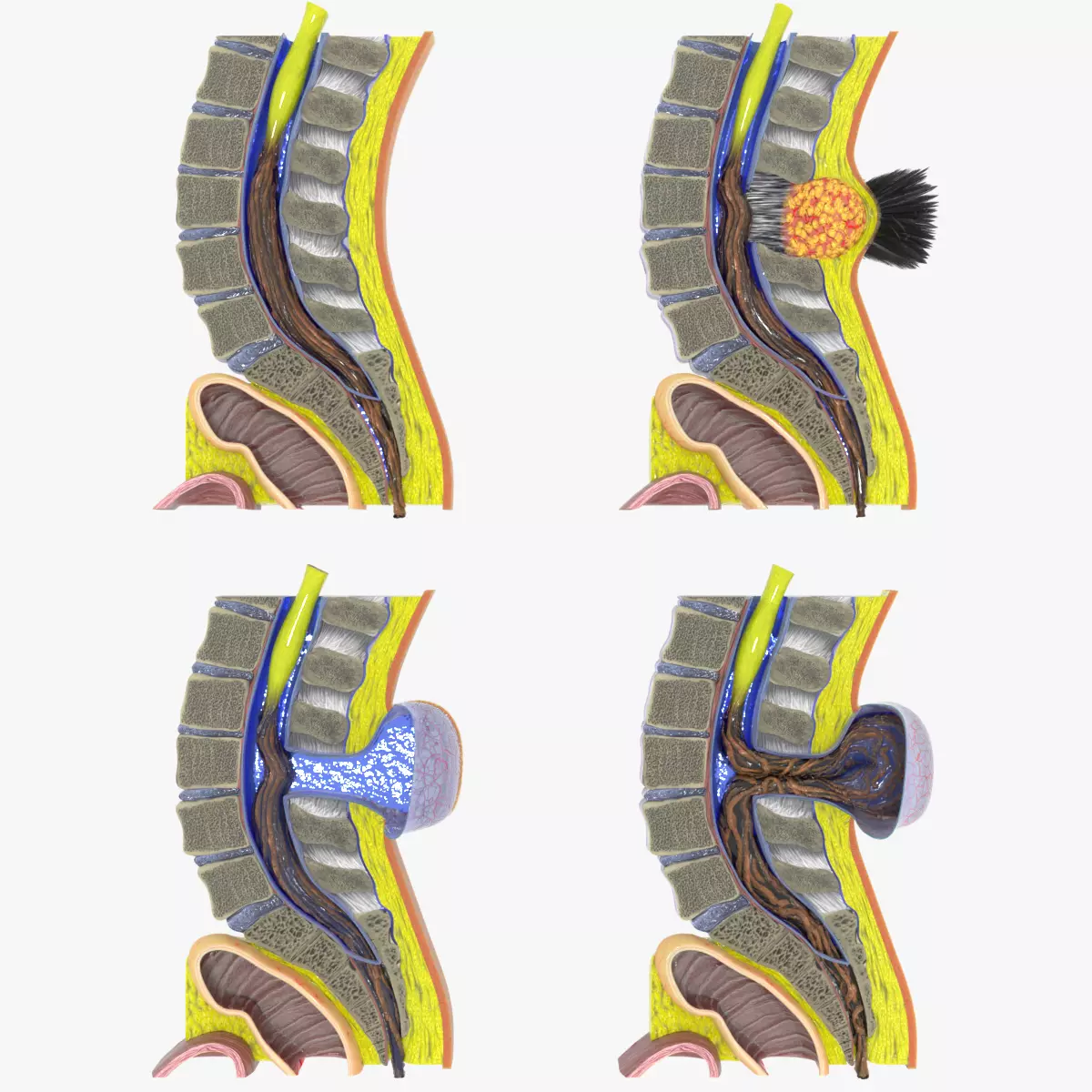 Spina bifida Neural Tube Defect Low-poly 3D model_0