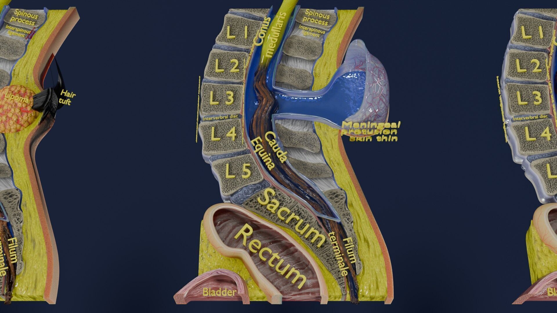 Spina bifida Neural Tube Defect Low-poly 3D model_42