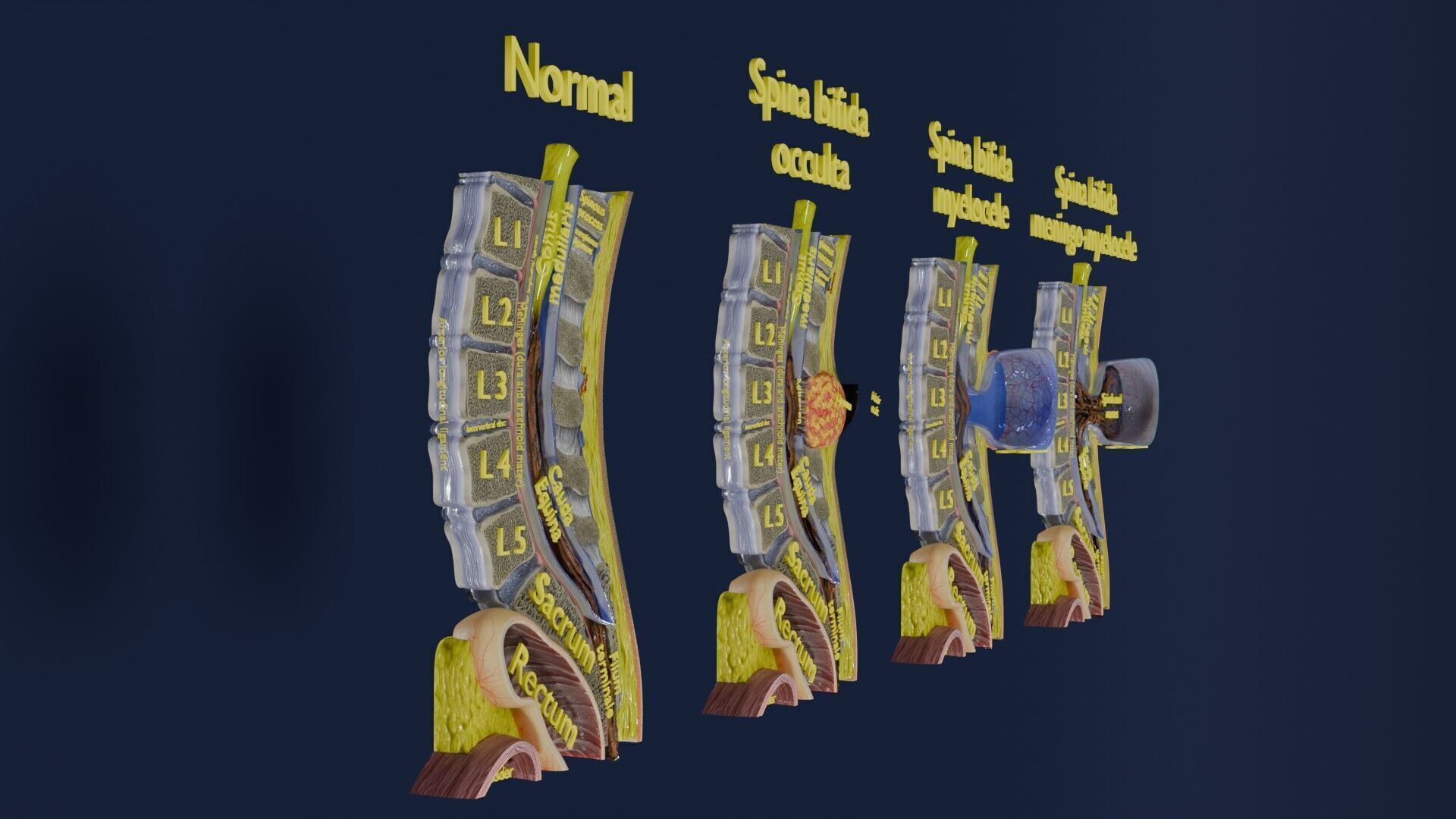 Spina bifida Neural Tube Defect Low-poly 3D model_5