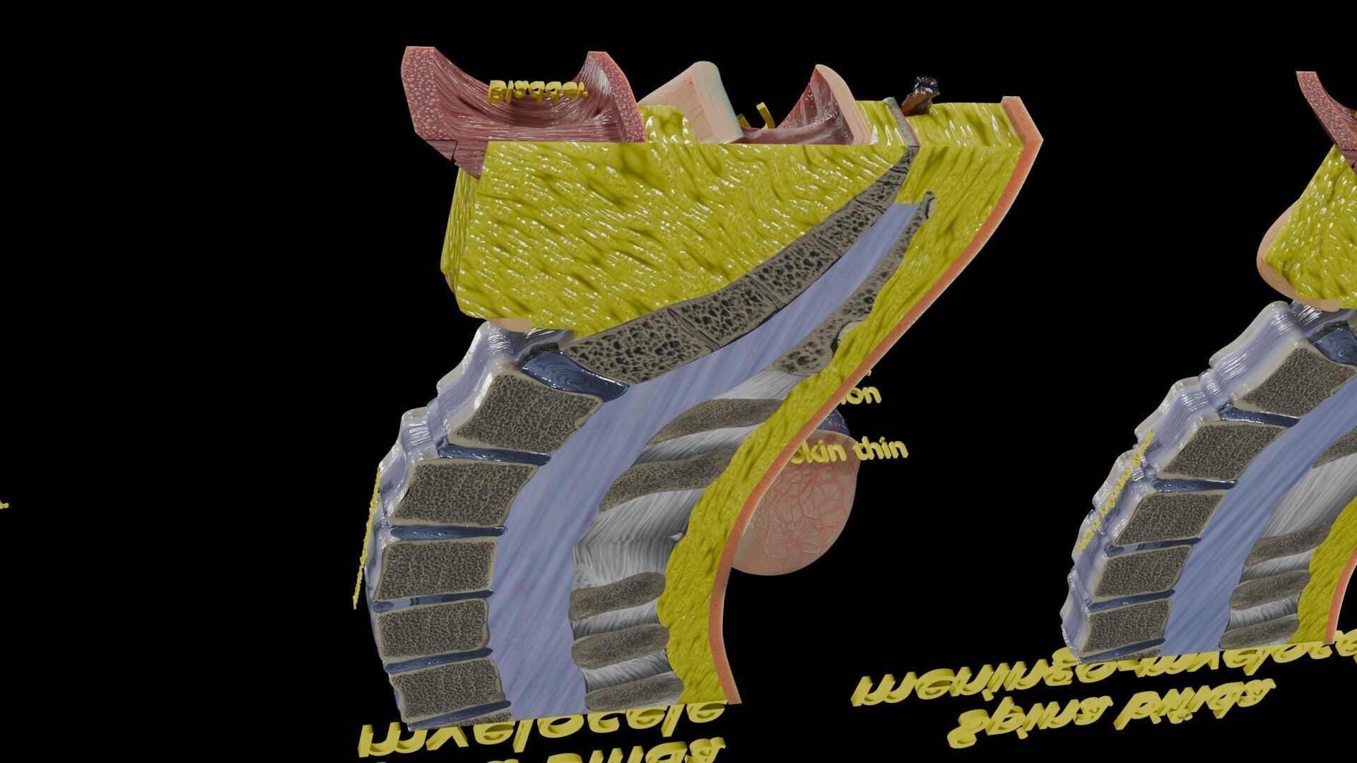 Spina bifida Neural Tube Defect Low-poly 3D model_65