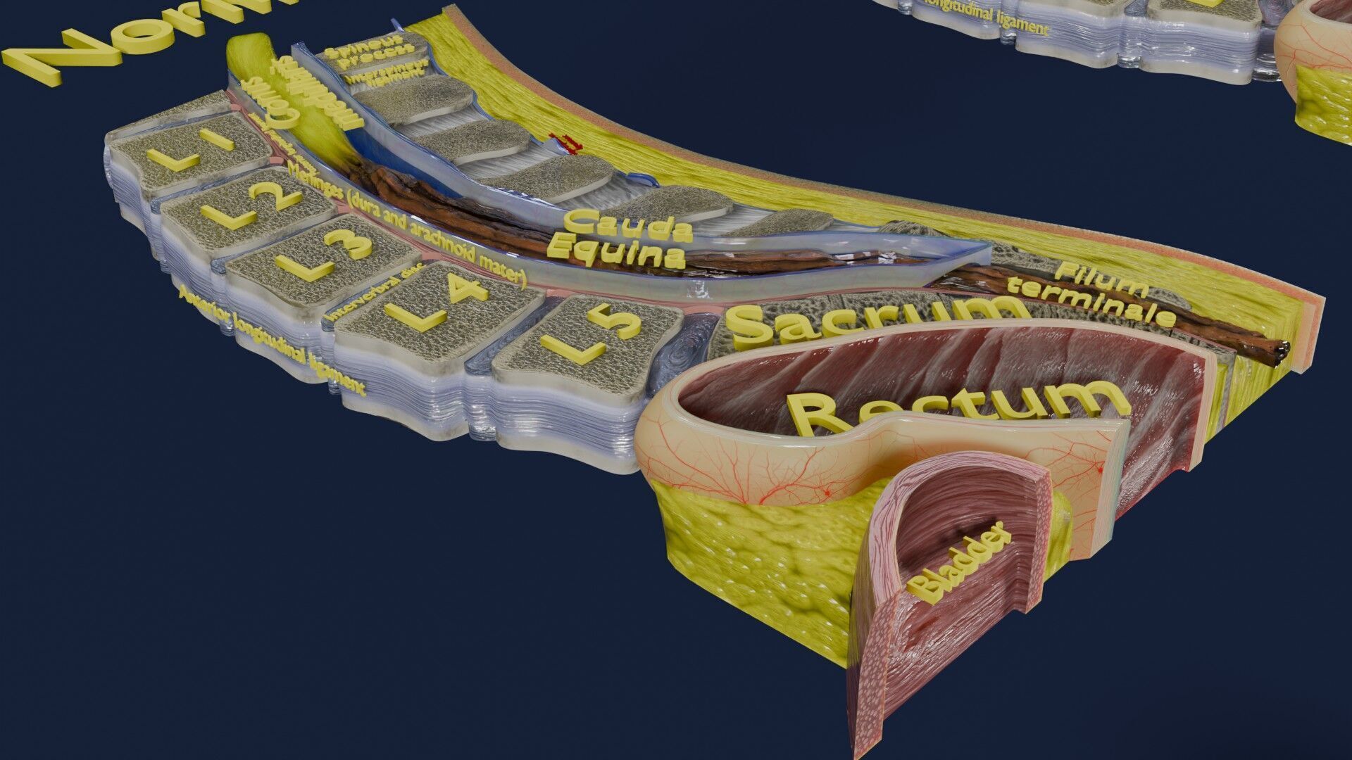 Spina bifida Neural Tube Defect Low-poly 3D model_17