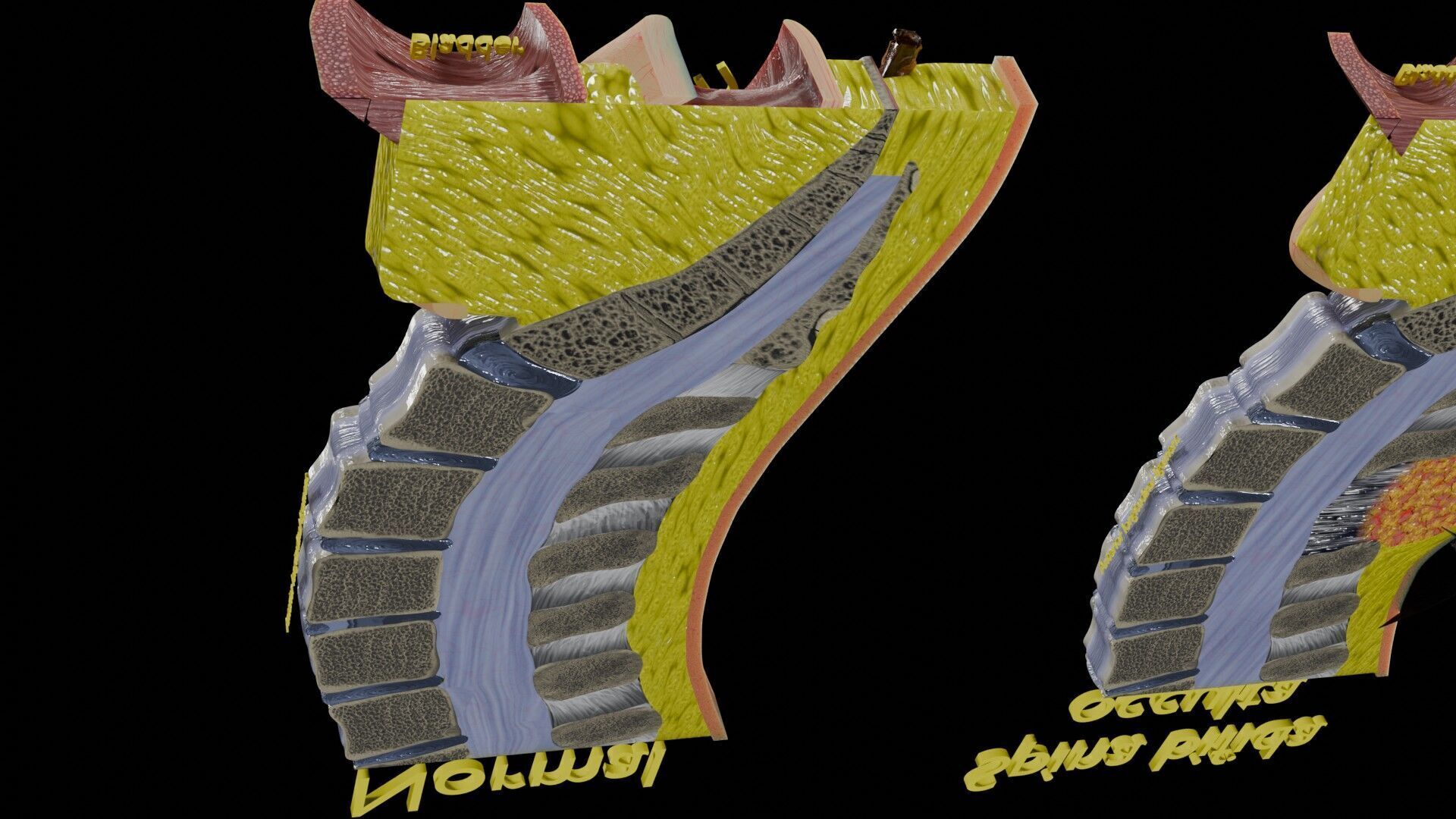 Spina bifida Neural Tube Defect Low-poly 3D model_24