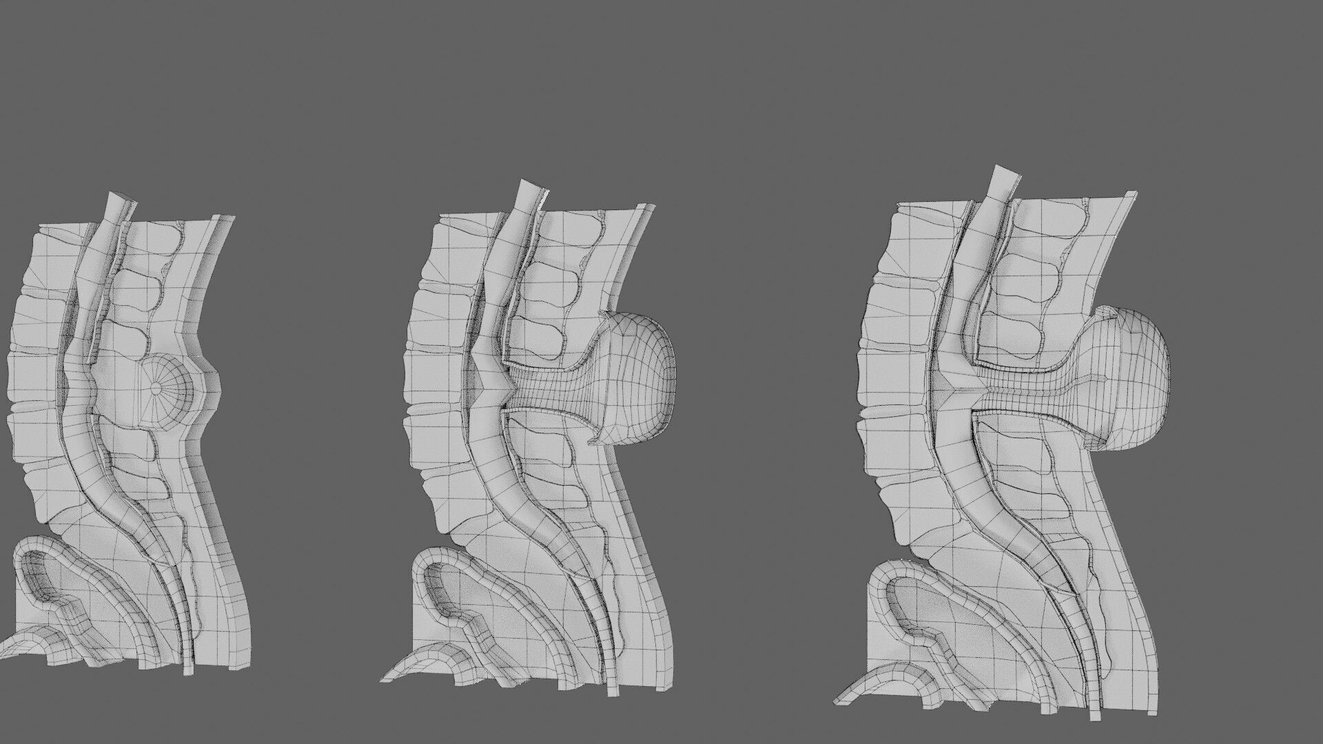 Spina bifida Neural Tube Defect Low-poly 3D model_76