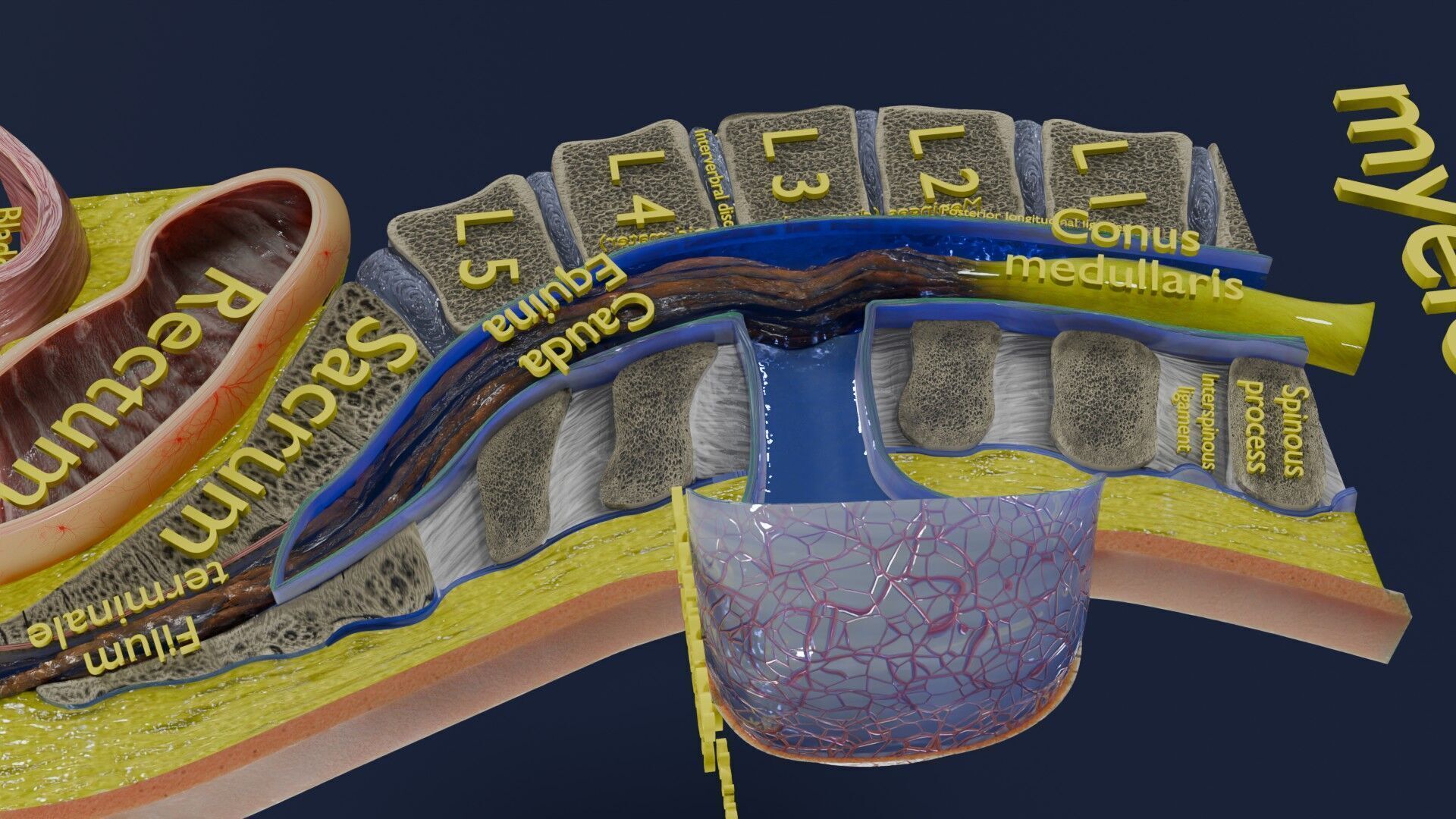 Spina bifida Neural Tube Defect Low-poly 3D model_62